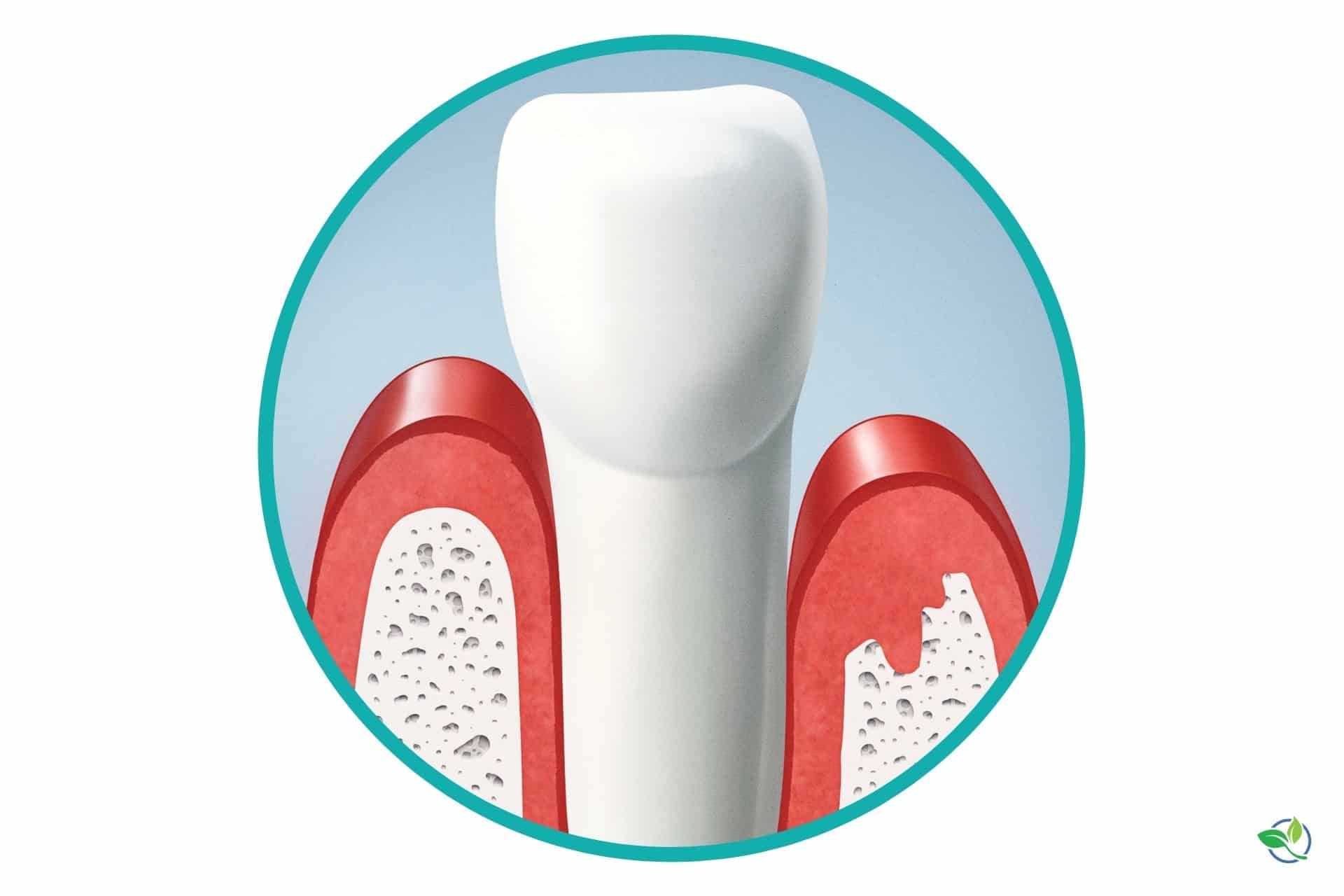 Gingivitis Vs Periodontitis The Mouth Body Connection Total Care