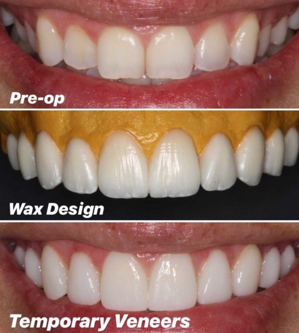 What Are Veneers? | Total Care Dental | Holistic Dentistry