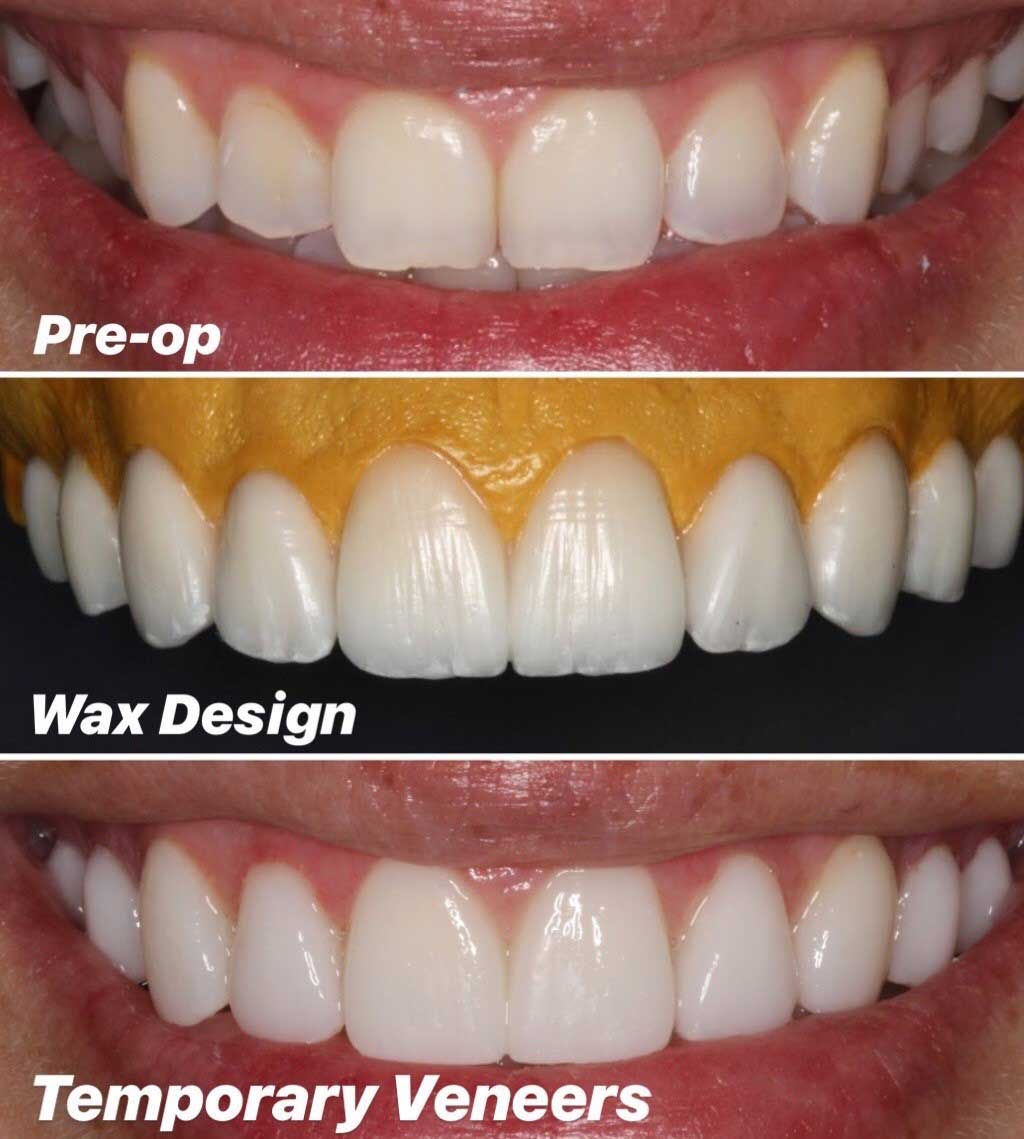 Veneer Process Teeth at kennethlqueen blog