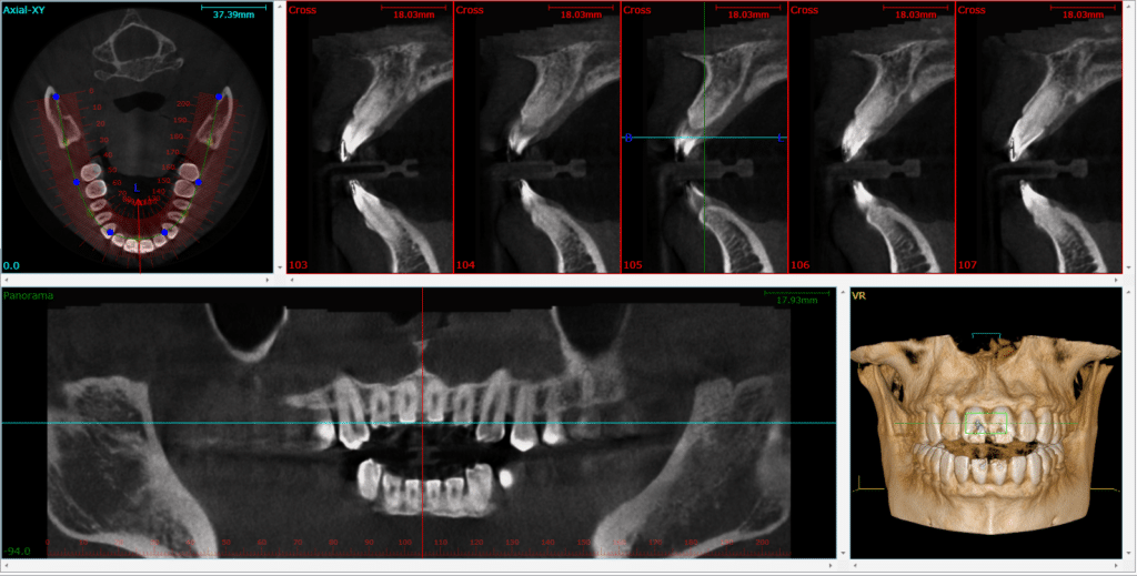 are-root-canals-safe-total-care-dental-holistic-dentistry