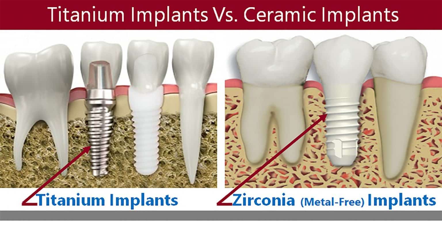 Dental Implants Total Care Dental Holistic Dentistry