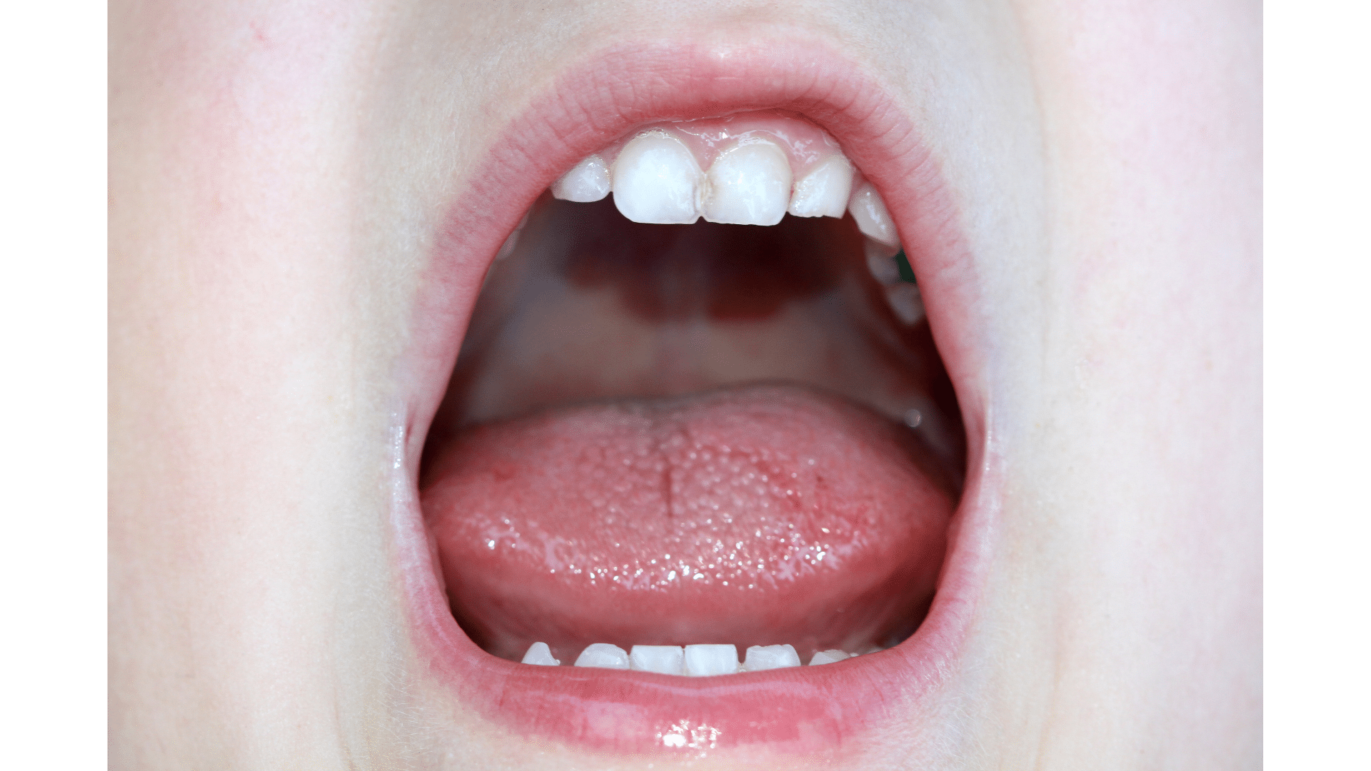 dry-mouth-cavities-total-care-dental-holistic-dentistry