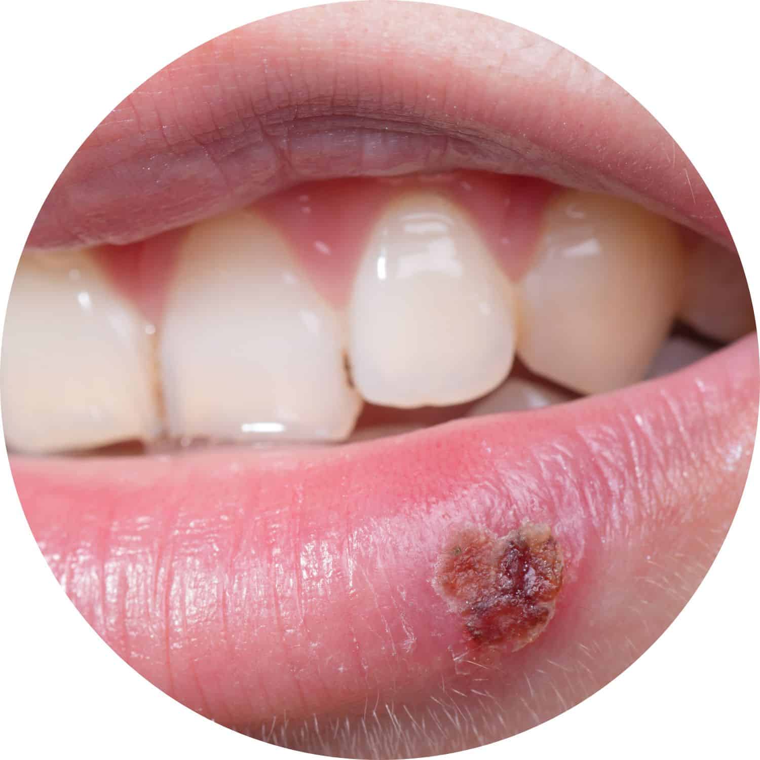 Cold Sore Or Canker Sore Total Care Dental Holistic Dentistry