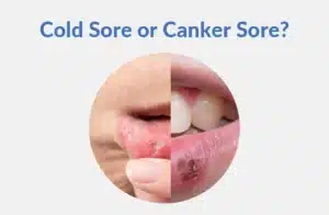 cold sore or canker sore?